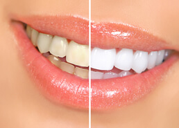 Schöne weiße Zähne